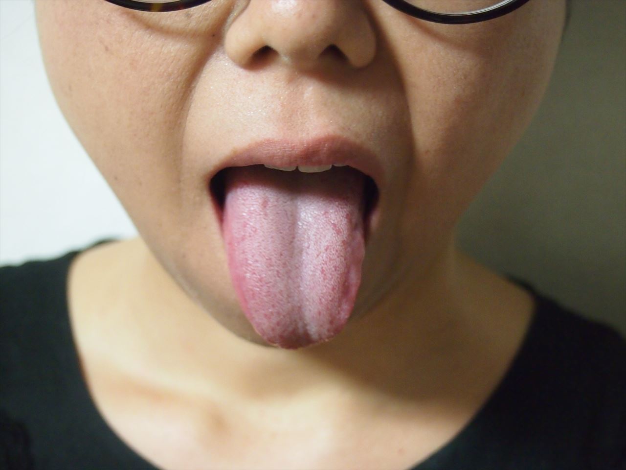 舌乳头炎你了解多少？再也不要害怕了！！！ - 知乎